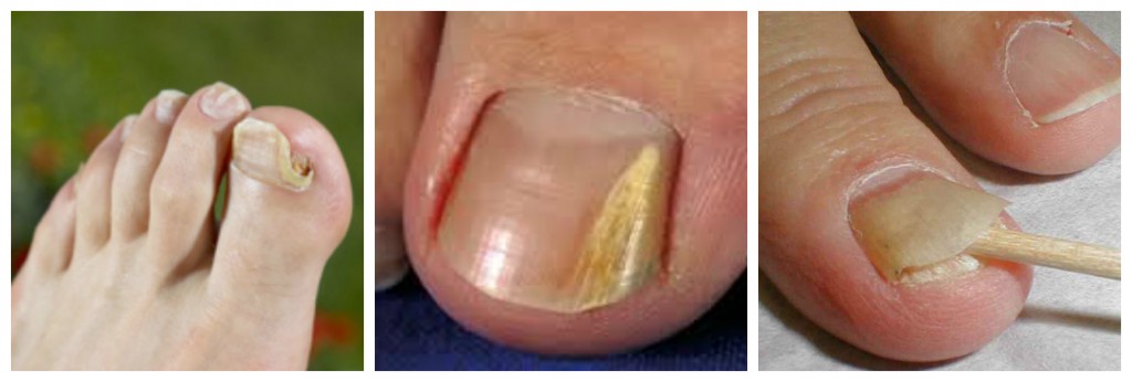 tratament ciuperca picioarelor si unghiilor cu remedii populare ce este ciuperca unghiilor de drojdie